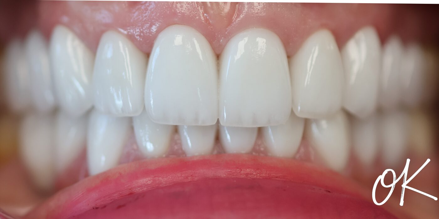 After porcelain veneers